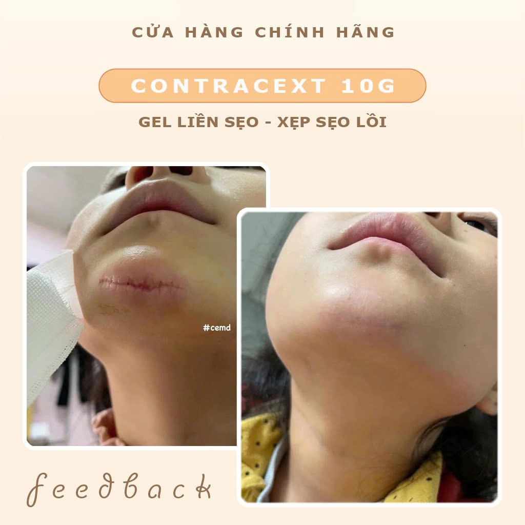 Gel cải thiện sẹo, sẹo lõm, sẹo thâm Contracext tuýp 10mg giảm và mờ sẹo Nga Beauty