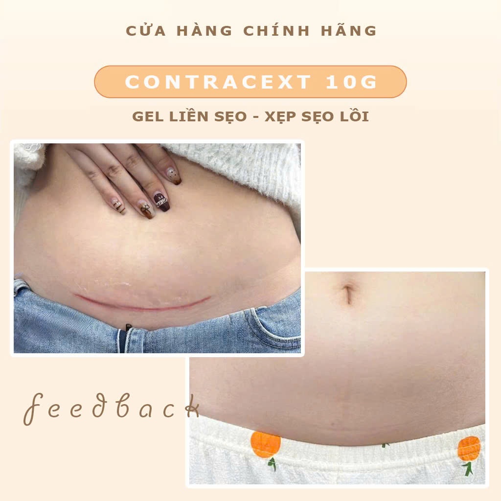 Gel cải thiện sẹo, sẹo lõm, sẹo thâm Contracext tuýp 10mg giảm và mờ sẹo Nga Beauty