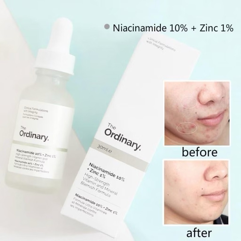 Tinh Chất THE ORDINARY Niacinamide 10% + Zinc 1% Kiềm Dầu, Giảm Thâm, Mụn ( 30ml )