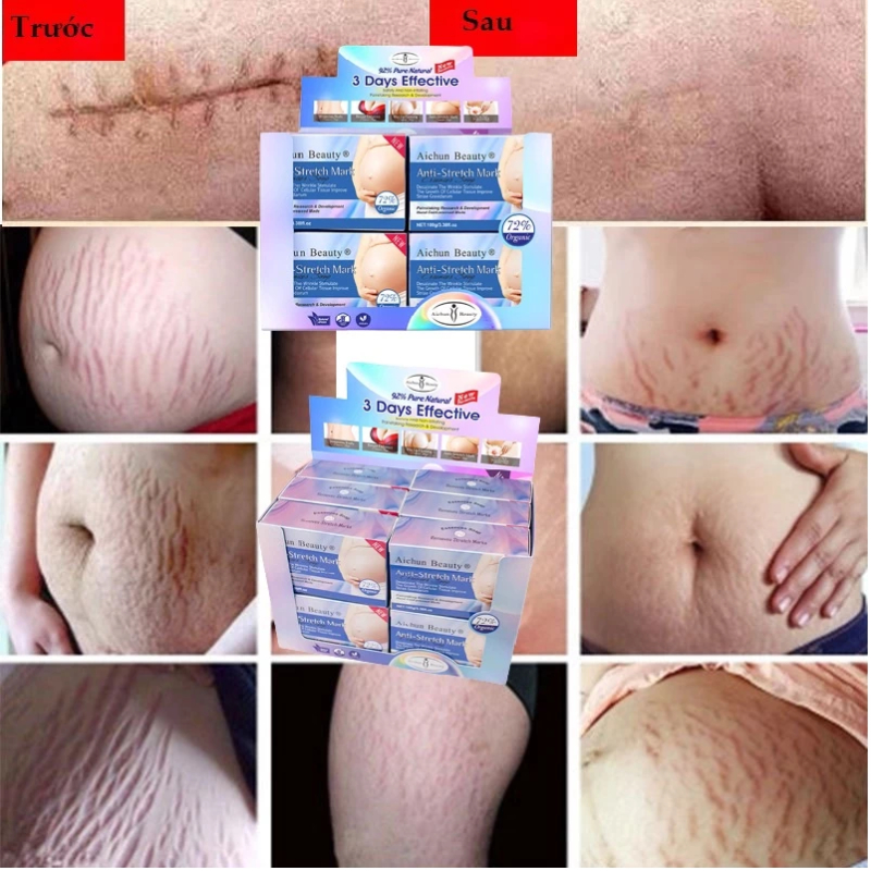 Xà Phòng Hỗ trợ Mờ Rạn Da, Mờ Thâm Sạm Da, trắng da Aichun Beauty