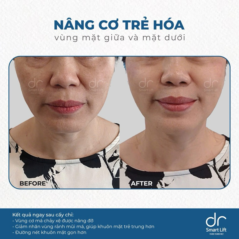 Cấy chỉ Dr smart Lift PDO trẻ hoá da chính hãng y khoa [hoả tốc]