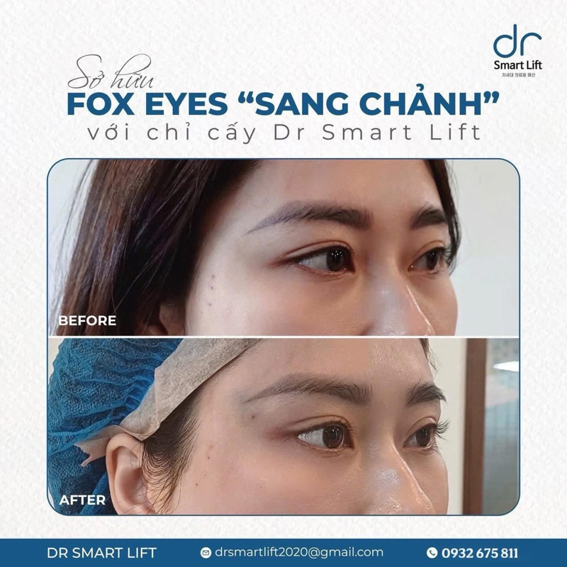 Cấy chỉ Dr smart Lift PDO trẻ hoá da chính hãng y khoa [hoả tốc]