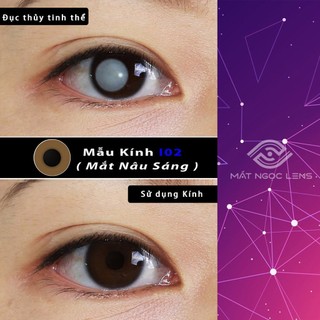 Lens thẩm mỹ - Kính áp tròng thẩm mỹ che khuyết điểm cho mắt đục thủy tinh thể, đốm trắng  tròng đen