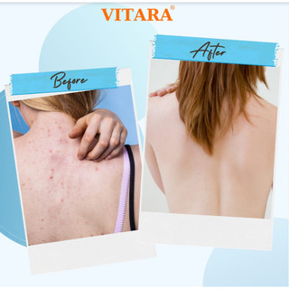 [CHÍNH HÃNG] Chai Xịt Mụn Lưng, Body VITARA SE Body Acne Spray 50ml - SHOP DẦU DOKRAK