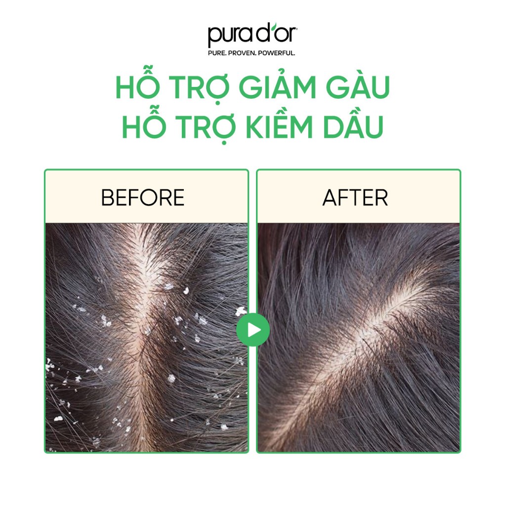 Ảnh Dầu Gội Hỗ Trợ Giảm Gàu, Dưỡng Tóc Chắc Khoẻ Scalp Therapy Organic Pura Dor 473ml 4