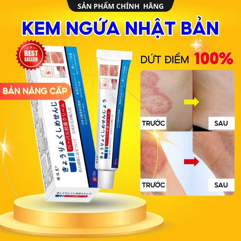 Kem Bôi Viêm Da Cơ Địa NHẬT BẢN Hết Lác Đồng Tiền, Hắc Lào, Ghẻ Nước, Á Sừng Cực Kì Hiệu Quả