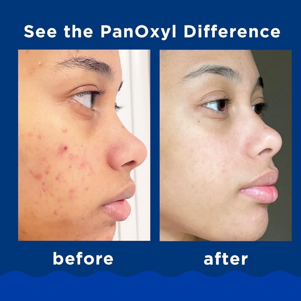 Sữa rửa mặt giảm mụn Panoxyl Creamy Acne Wash 4% - Foaming Acne Wash 10% Benzoyl Peroxide ngực,gigi