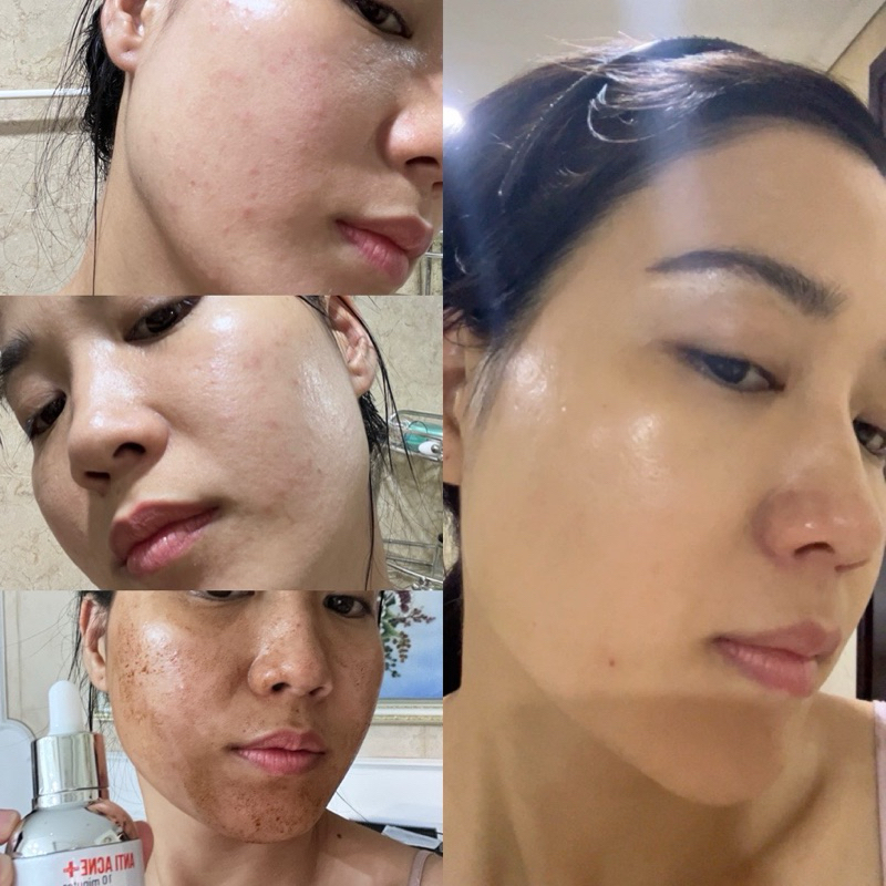 Combo serum Relicos anti acne plus 28ml sạch mụn và sữa rửa mặt Relicos sạch da, kháng khuẩn