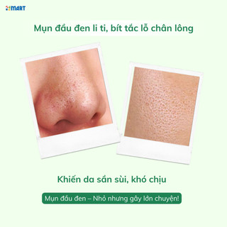 Cây đẩy mụn đầu đen chuyên dụng dùng để loại bỏ mụn đầu đen, tế bào chết