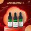 Serum mụn Anti Blemish 5ml ADA Group