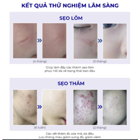 Scar Esthetique 30ml Rejuvaskin kem xóa sẹo thâm/ rỗ/ lõm date 2028