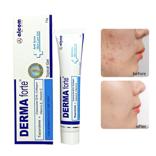 Gel Derma Forte - Làm mờ sẹo, ngừa vết thâm, ngừa tái phát mụn, sạch bã nhờn trên da (Tuýp 15g)
