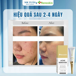 Kem Chấm Mụn Acne Remover Renoskin 10ml Dạng Kem Giúp Làm Dịu Và Se Nhanh Cồi Mụn, Dễ Thẩm Thấu, Không Bết Dính