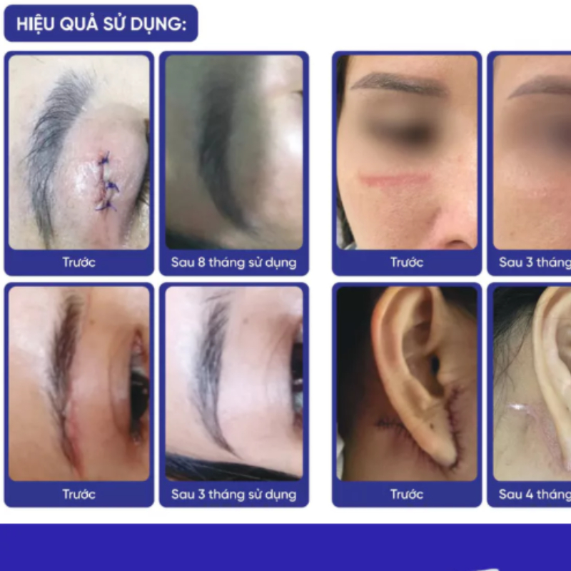 Rejuvasil Kem Sẹo Lồi, Sẹo Phẫu Thuật Siêu Mượt 30ml