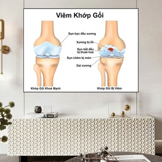 [Tranh Y Khoa] Tranh Tráng Gương Bo Viền Cao Cấp - Tranh Viêm Khớp Gối