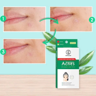 Miếng Dán Mụn Acnes Giúp Giảm Mụn Sưng Viêm 24 miếng