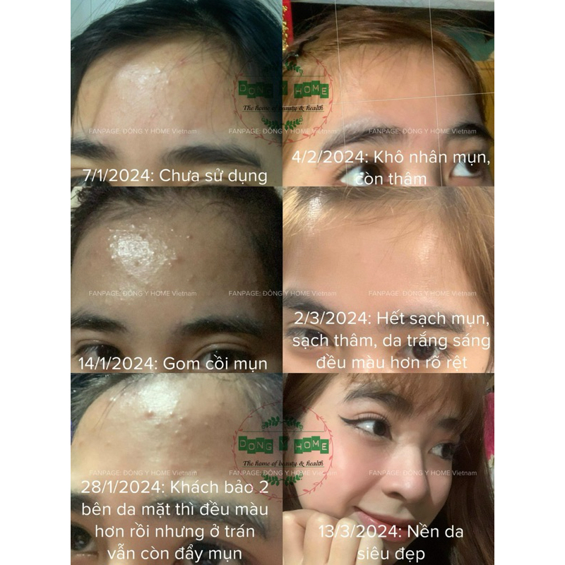 Kem Chấm Mụn Đông Y Home 20g: Hỗ Trợ Cải Thiện Thâm, Làm Đẹp Da, Skincare