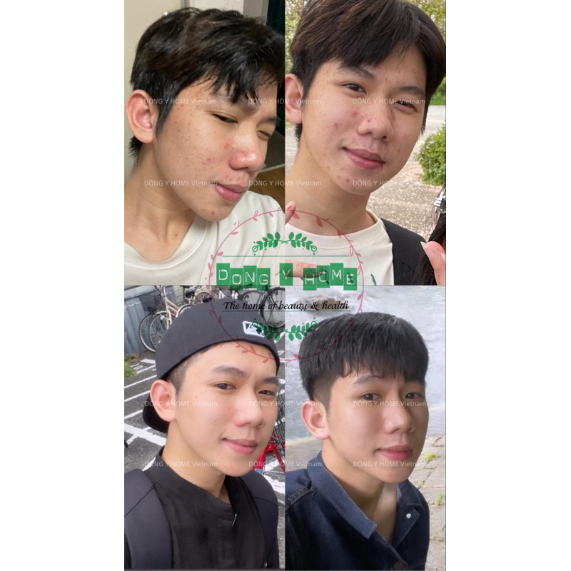 Kem Chấm Mụn Đông Y Home 20g: Hỗ Trợ Cải Thiện Thâm, Làm Đẹp Da, Skincare