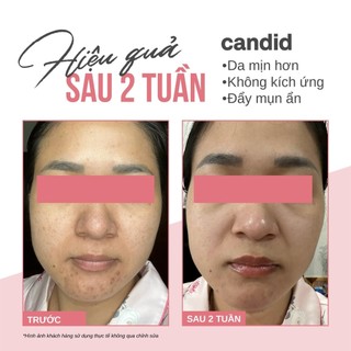 [DEAL CANDID 02] Tinh Chất Trẻ Hóa Candid Retinol 0.5/1.0 Tặng Kem Dưỡng Cấp Ẩm B5 CiCa Cream 50ML