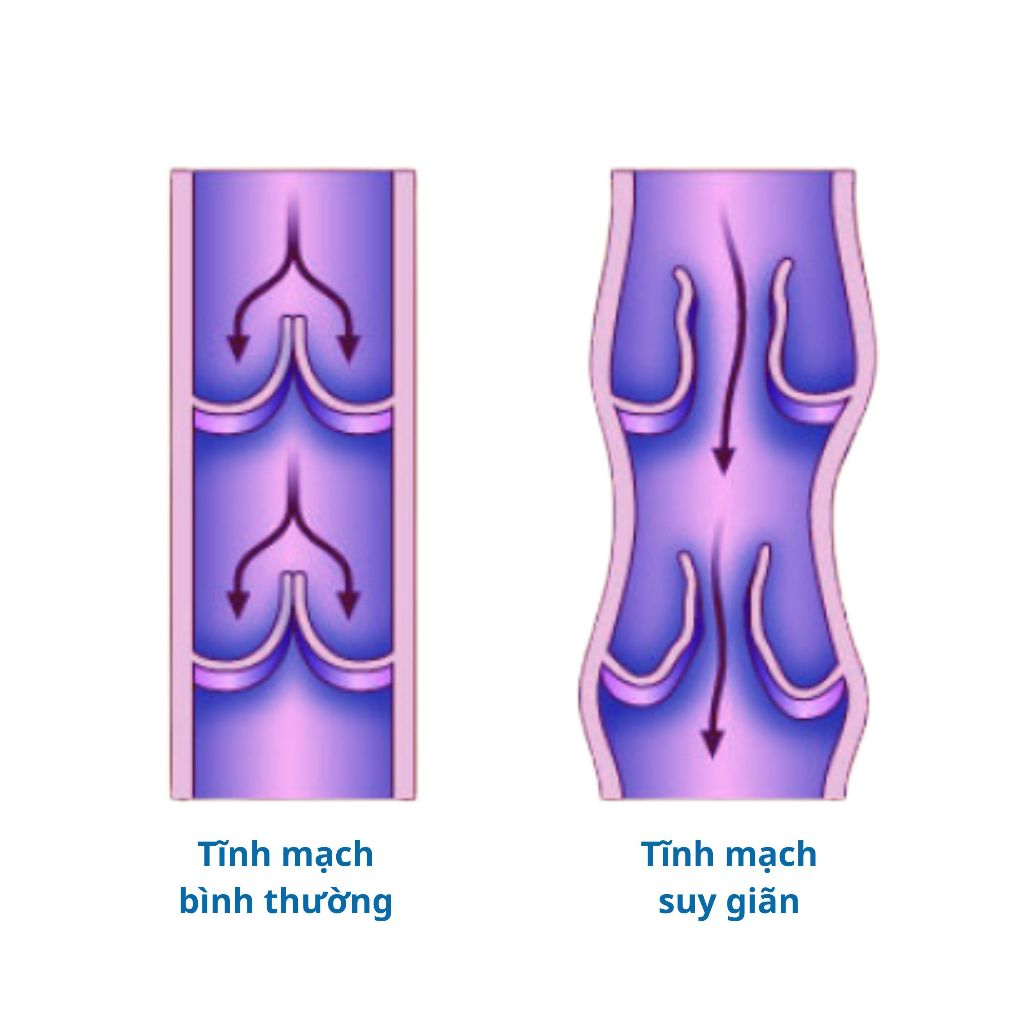 Vớ đùi y khoa Belsana Classic AG tất phòng ngừa suy giãn tĩnh mạch sản xuất tại Đức