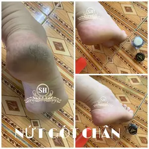 01 hũ dưỡng cứng móng - bong tróc da tay chân - nứt gót chân