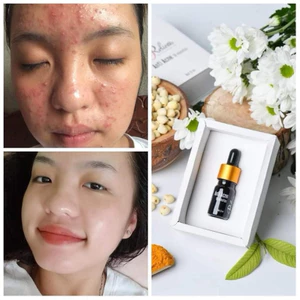 Serum sạch mụn Relicos loại trừ mụn tận gốc (date mới nhất 2028 chính hãng cty)