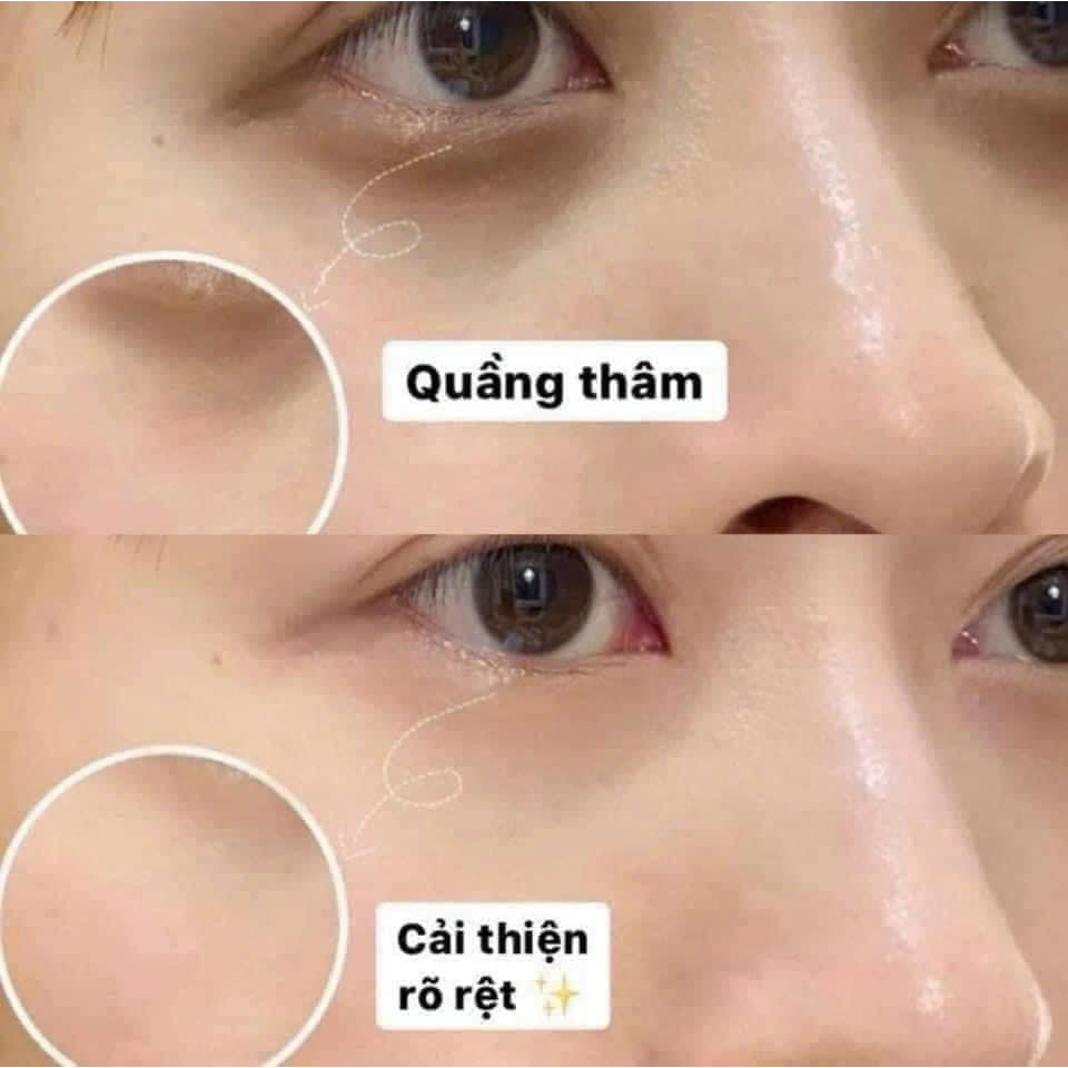 Kem Thâm Mắt YANHEE EYE Cao Cấp Kem Dưỡng Mắt Loại Bỏ Quầng Thâm Bọng Mắt Chống Lão Hóa Xóa Mờ Nếp Nhăn