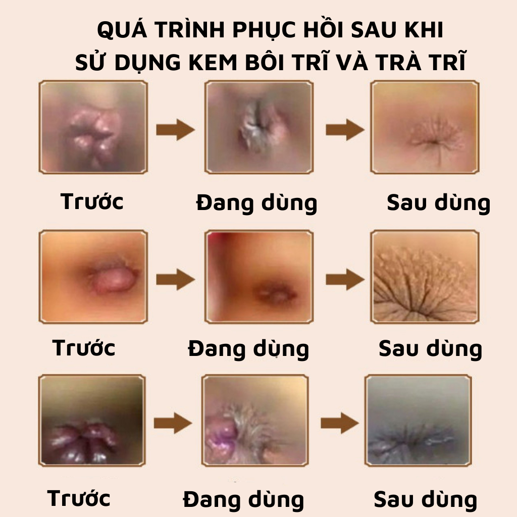 [Trĩ tái đi tái lại] Trà trĩ Calen Nature Farm cho người trĩ nội, trĩ ngoại, trĩ lâu năm tái đi tái lại bịch 30 gói lọc