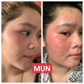 COMBO GEL MỤN + SỮA RỬA MẶT B5