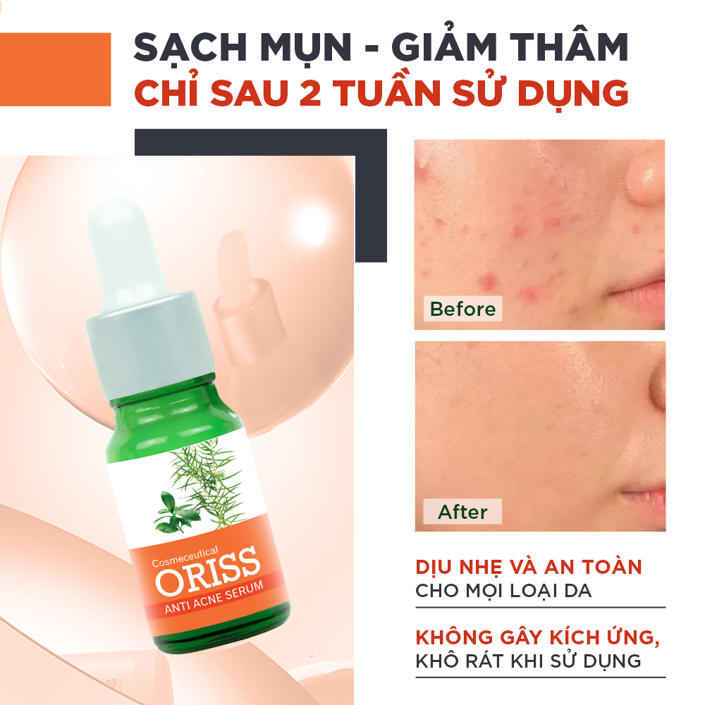 Ảnh Serum giảm mụn Oriss tinh chất tràm trà hỗ trợ mờ thâm sạch mụn 10g 2