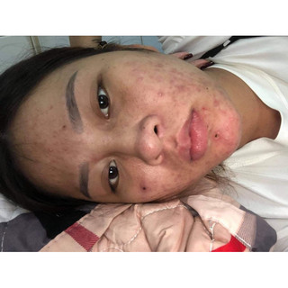 M22 - Huyết sâm mụn Lkaori (Chính Hãng)