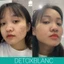 SERUM MỤN PEEL ACNES BLANC - H DETOXBLANC Hỗ trợ giảm các tình trạng mụn thâm