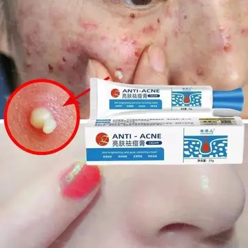 Kem làm trắng mụn Kem làm trắng mụn Gel Kem loại bỏ mụn - Serum giảm mụn làm dịu và dưỡng ẩm cho da và giảm sẹo mụn