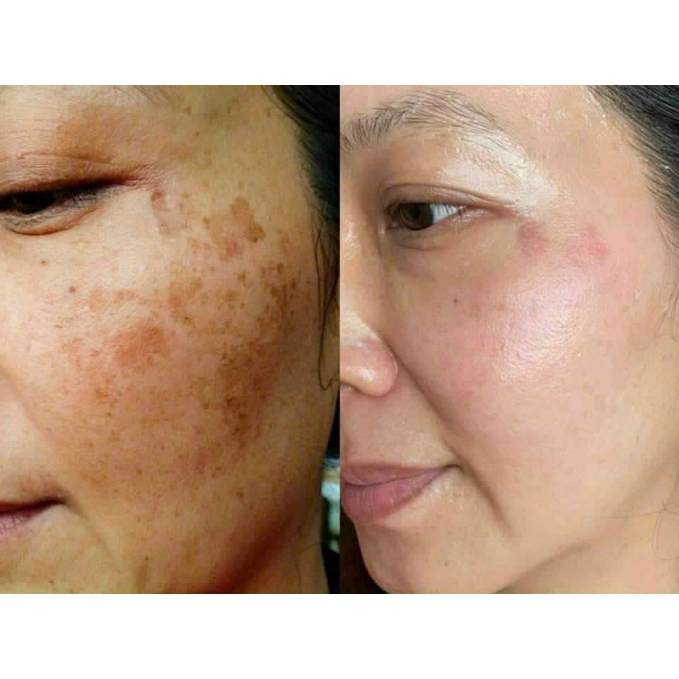 Kem Dưỡng Trắng Da MeSo Siêu Căng Bóng Da, Tái Tạo Da Mịn Màng, Mờ Thâm Nám Tàn Nhang Dưỡng Ẩm Da Mướt Hủ 30gr