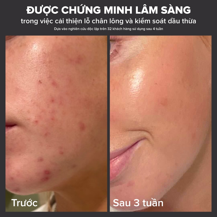 Ảnh Dung dịch loại bỏ tế bào chết Paula's Choice 2% BHA 30ml Mã 2016+ 2