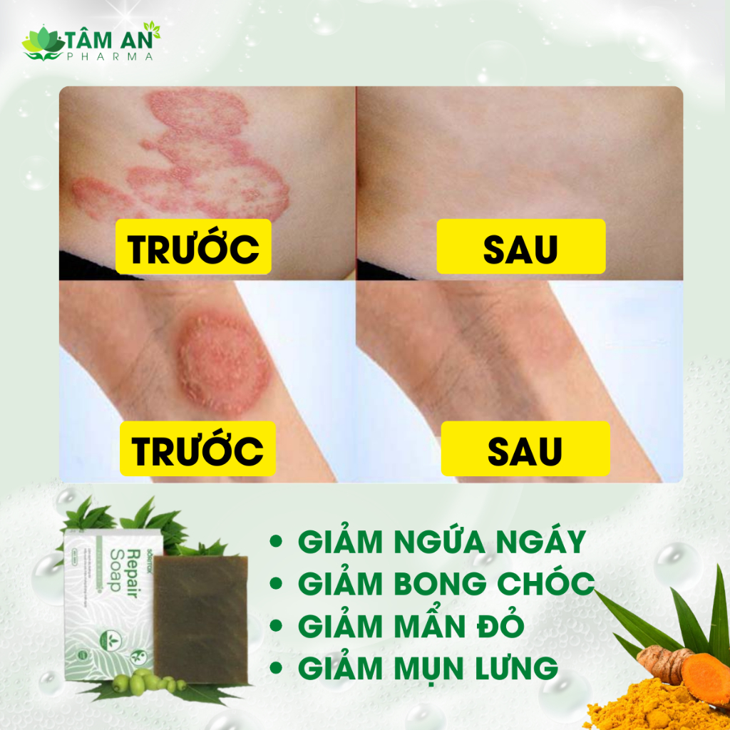 [MUA 3 TẶNG 1] Xà Bông Thảo Mộc Cho Da Vảy Nến, Viêm Da, Hắc Lào, Mẩn Ngứa, Bong Chóc SORITOX 100GR XB-3T
