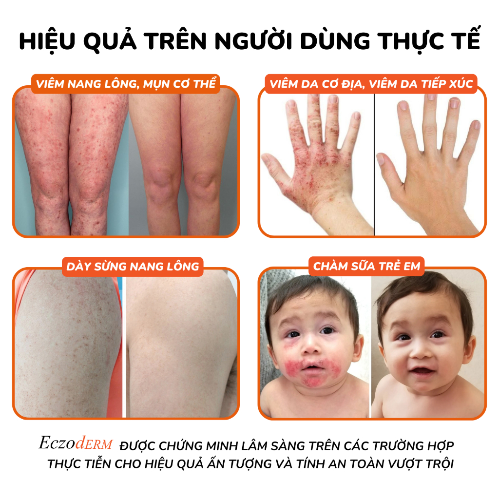 Kem Eczoderm Hỗ Trợ Eczema,Viêm Nang Lông, Viêm Da Cơ Địa, Mụn Lưng, Mụn Cơ thể, Chàm Sữa Chính Hãng