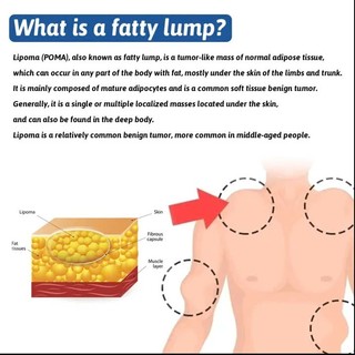 [HCM] Kem mềm u mỡ, xử lý hạt mỡ, loại bỏ nhiều khối u mỡ tuyến giáp và u mỡ dưới da 50g