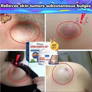 [HCM] Kem mềm u mỡ, xử lý hạt mỡ, loại bỏ nhiều khối u mỡ tuyến giáp và u mỡ dưới da 50g