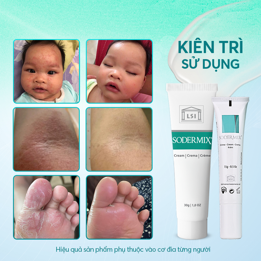 Ảnh Kem Bôi Viêm Da Cơ Địa SODERMIX Hỗ Trợ Giảm Ngứa Ngáy, Eczema, Chàm Sữa, Tổ Đỉa, Dưỡng Ẩm - Nhập Khẩu Từ Pháp 1