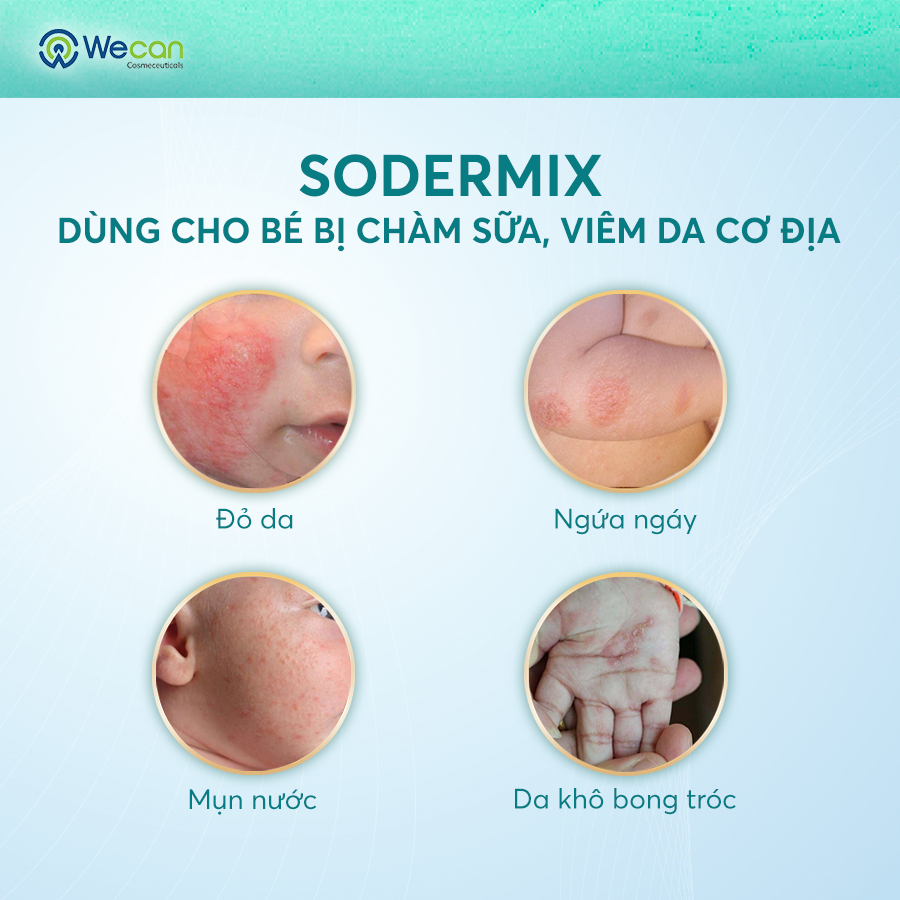 Ảnh Kem Bôi Chàm Sữa SODERMIX 30g - Tặng Mây Hồng Cho Mẹ - Hỗ Trợ Giảm Ngứa Ngáy, Viêm Da Cơ Địa, Mẩn Đỏ, Dưỡng Ẩm Cho Bé 2