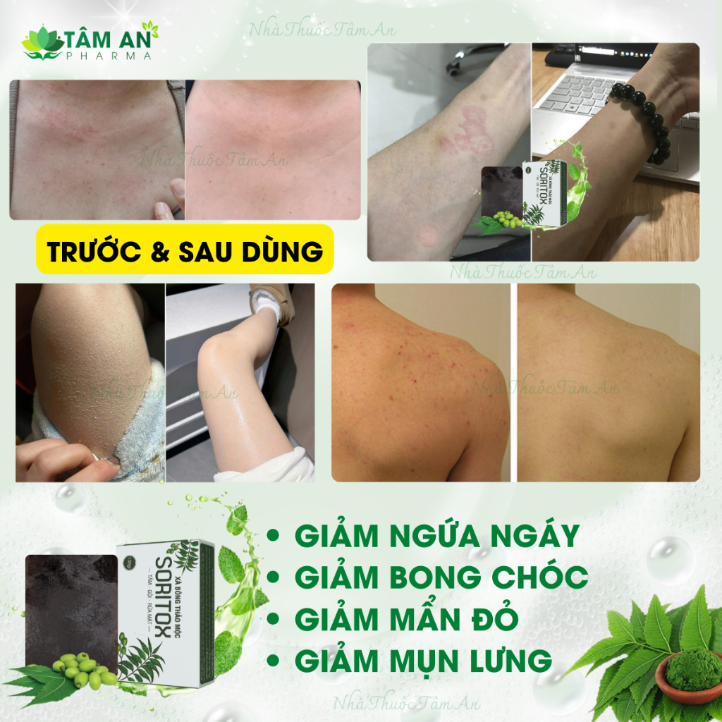 Xà Bông Tắm Cho Vảy Nến, Viêm Da, Ngứa Đỏ, Bong Chóc Từ Thảo Mộc Lá Neem Soritox 100Gr [XBX]