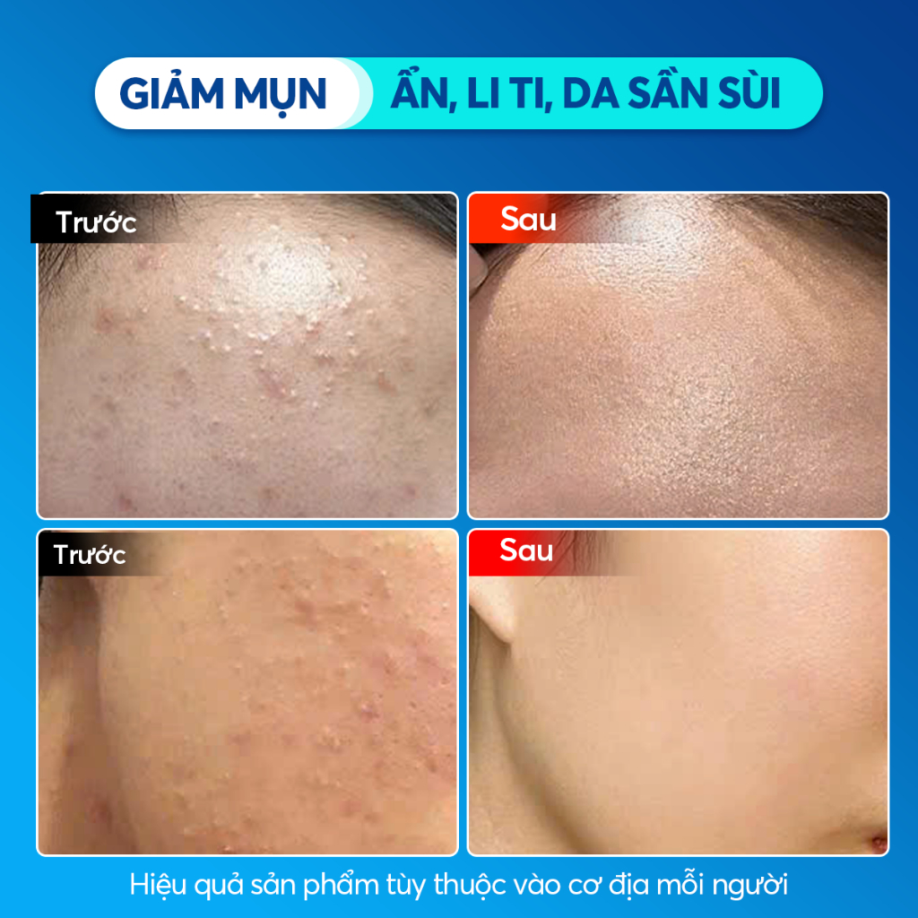 Ảnh Gel Giảm Mụn Sahemul Sensitive Giảm Mụn Viêm, Mụn Ẩn, Mụn Đầu Đen 20gr [TẶNG KEM MỤN 10GR] 1