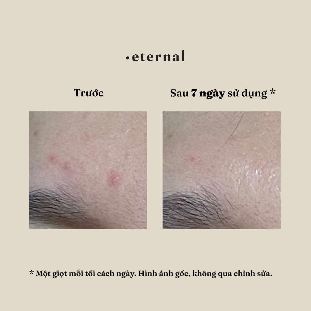 Tinh Chất Ao Thu Eternal 30ml – Serum Retinol Giảm Mụn, Dưỡng Da, Ngừa Thâm