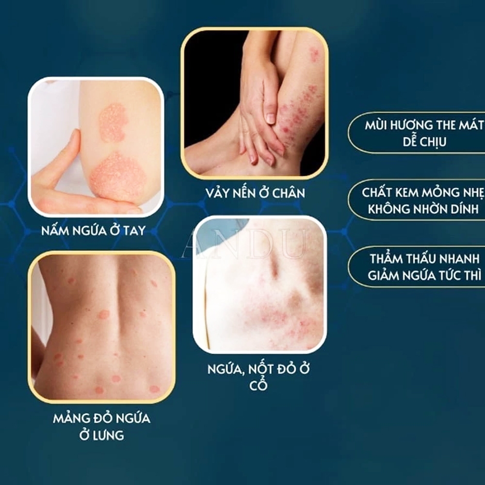 Kem Bôi Nấm Ngứa Viêm Da Cơ Địa NHẬT BẢN dứt điểm Nấm Da đầu, Ghẻ nước Tay Chân, Hắc lào, Tổ đỉa, Vẩy nến Hiệu Quả