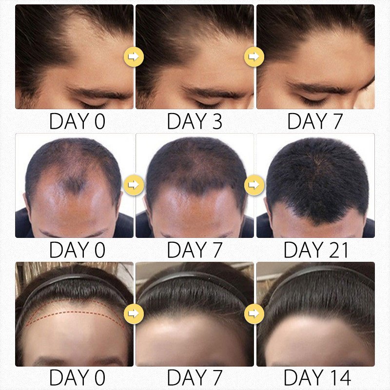 Tinh dầu mọc tóc Xịt mọc tóc Serum chống rụng tóc 30ml Thành phần thảo dược giúp tóc mọc hiệu quả