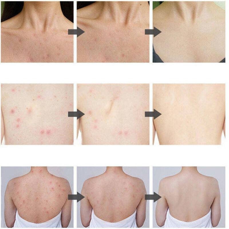 Sữa tắm xà phòng lưu huỳnh Sữa tắm chống ngứa Sữa tắm mụn Sữa tắm diệt mạt ve 500ml