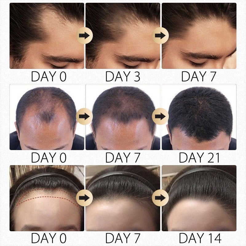 Serum mọc tóc Tinh chất thảo dược chống rụng tóc Giúp tóc mọc hiệu quả Nuôi dưỡng da đầu 50ml