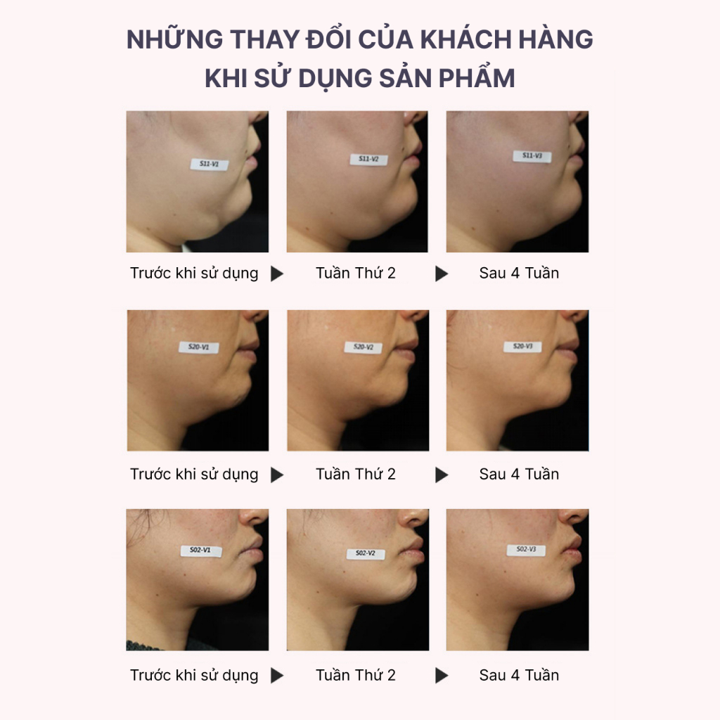 Mặt Nạ Nâng Cơ Hình Chữ V , Tái Sử Dụng Lâu Dài, Thon Gọn Định Hình Khuôn Mặt Vline - Aimanfun Việt Nam