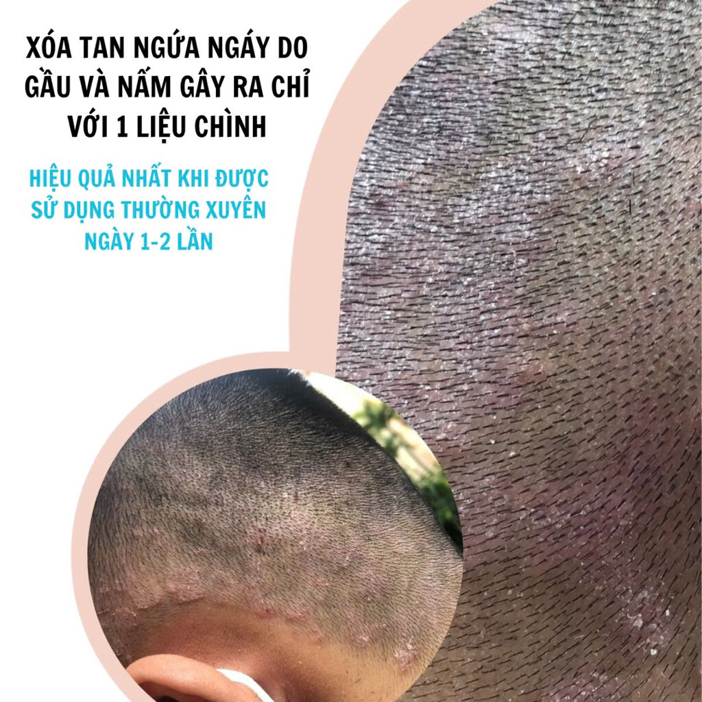Dầu Gội   Đánh Bay Gàu Nấm Rồng Đen , Dầu Gội xuân Phong Kích Mọc Tóc , Phục hồi Tóc và da đầu bị tổn thương